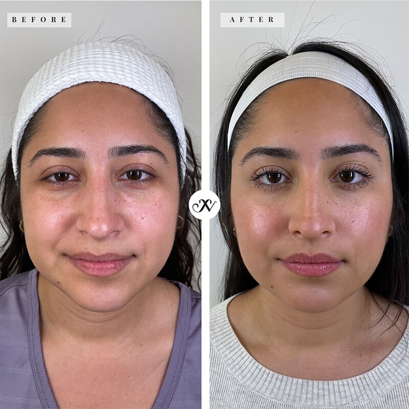 Dermal Fillers - Mid Face Before & After Image